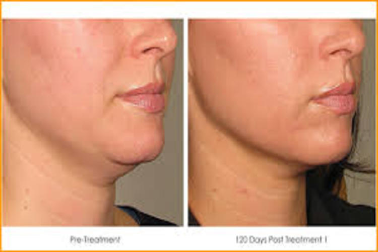 Lifting facial Hifu Brasov